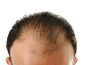 implanty włosów